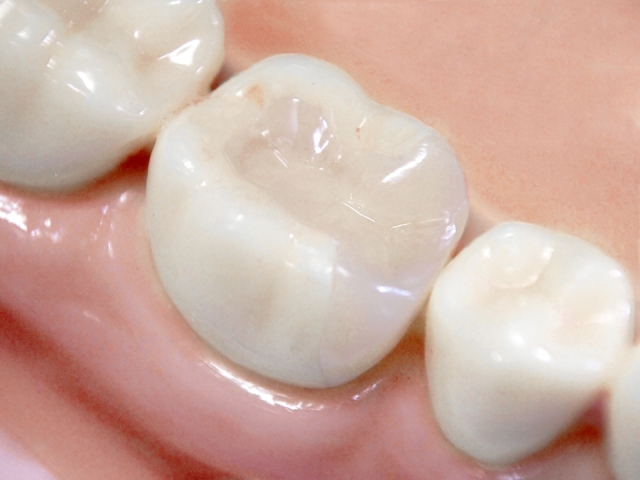 歯 の 詰め物 種類